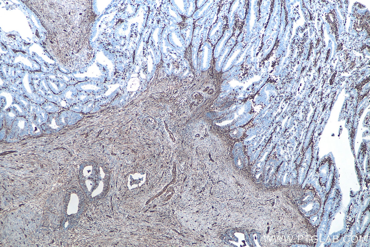 IHC staining of human endometrial cancer using 60330-1-Ig Immunohistochemistry (IHC) staining of human endometrial cancer tissue using Vimentin Monoclonal antibody (60330-1-Ig)