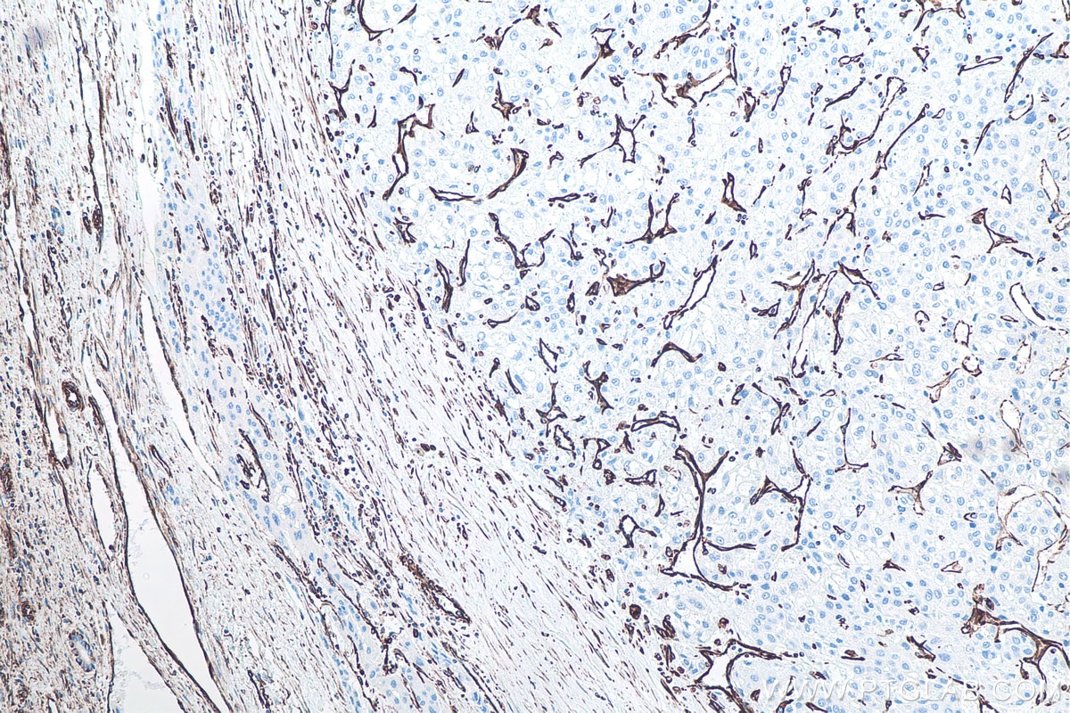 IHC staining of human liver cancer using 60330-1-Ig Immunohistochemistry (IHC) staining of human liver cancer tissue using Vimentin Monoclonal antibody (60330-1-Ig)