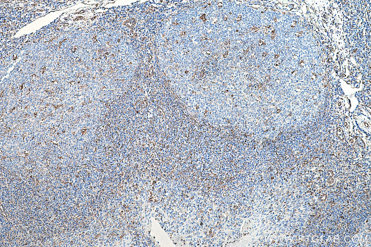Immunohistochemistry (IHC) staining of human tonsillitis tissue using Vimentin Monoclonal antibody (60330-1-Ig)