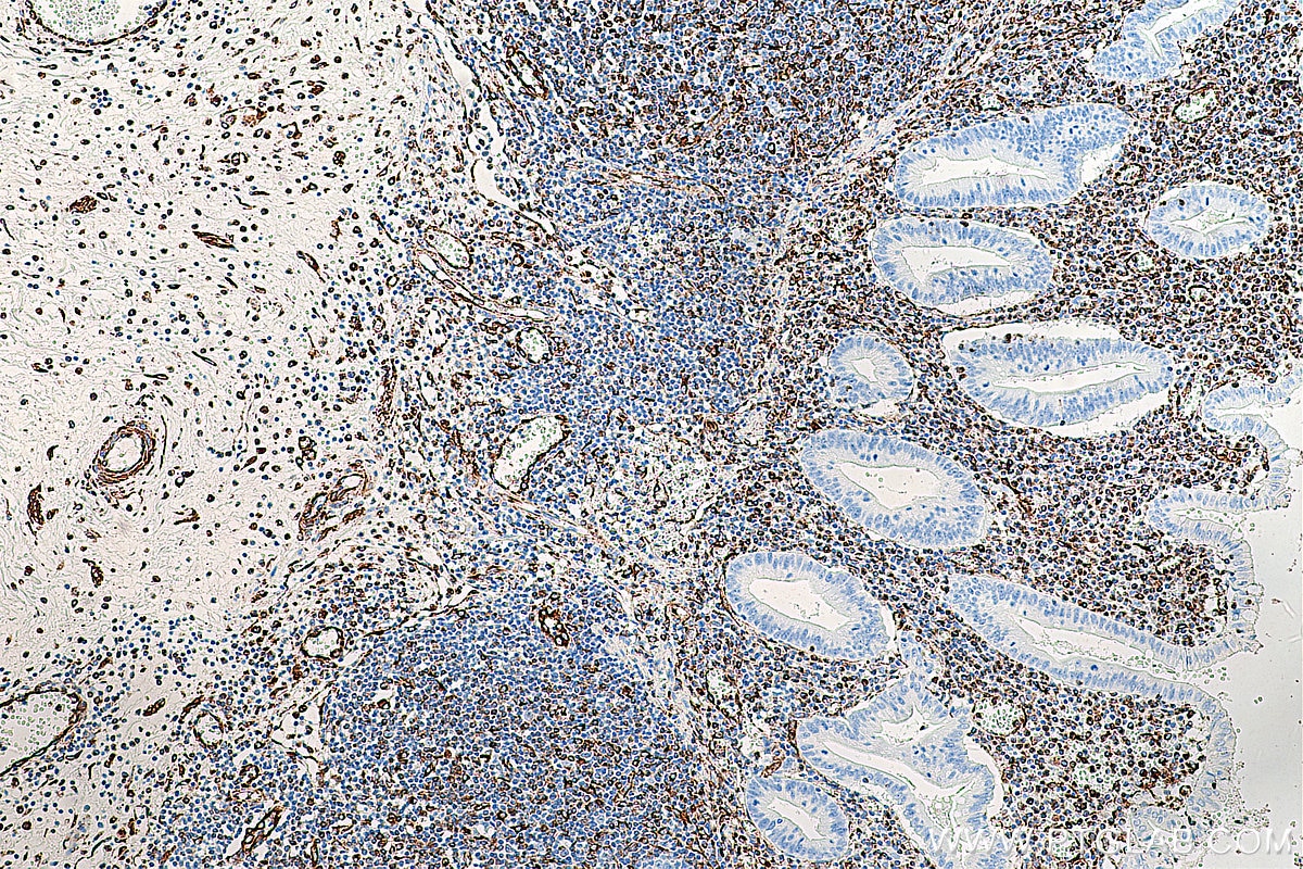 Immunohistochemistry (IHC) staining of human appendicitis tissue using Vimentin Monoclonal antibody (60330-1-Ig)