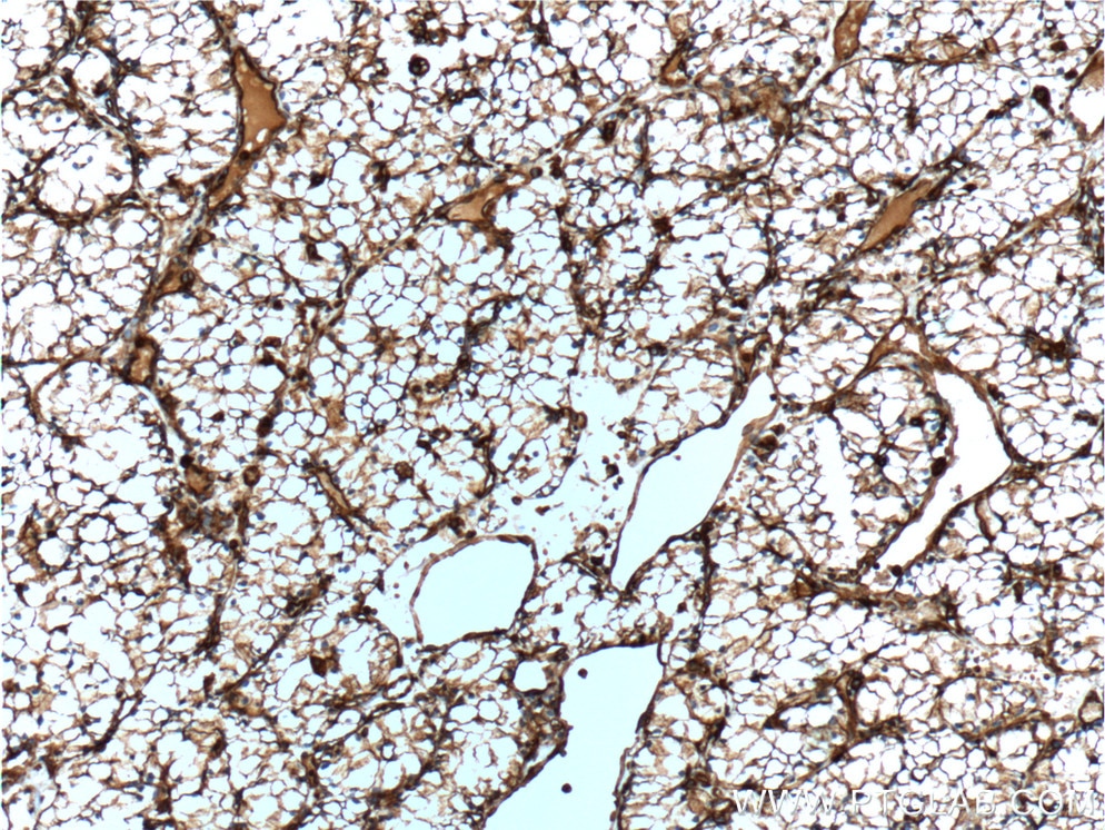 Immunohistochemistry (IHC) staining of human renal cell carcinoma tissue using Vimentin Monoclonal antibody (60330-1-Ig)