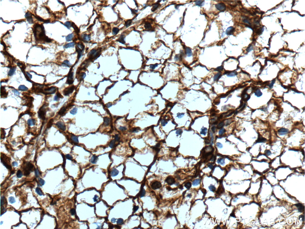 Immunohistochemistry (IHC) staining of human renal cell carcinoma tissue using Vimentin Monoclonal antibody (60330-1-Ig)