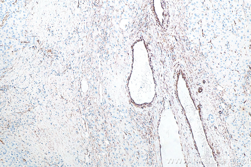 IHC staining of human liver cancer using 80232-1-RR