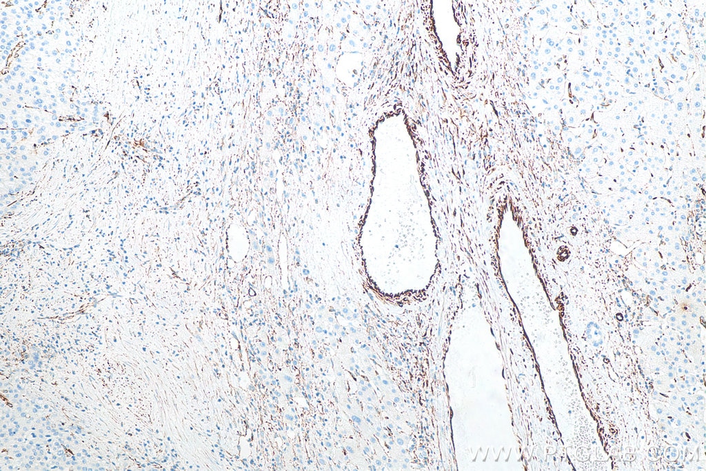 Immunohistochemistry (IHC) staining of human liver cancer tissue using Vimentin Recombinant antibody (80232-1-RR)