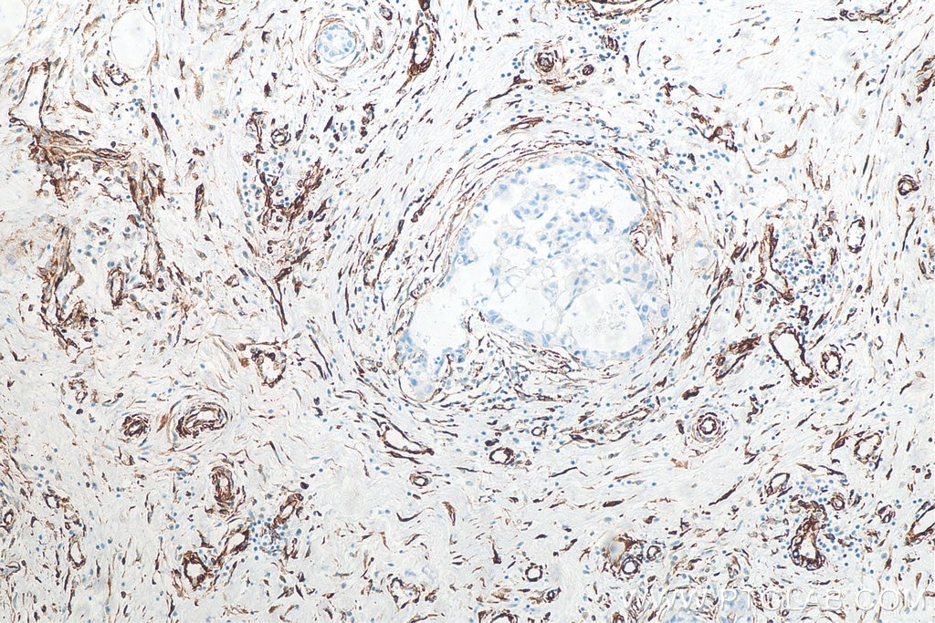 Immunohistochemistry (IHC) staining of human breast cancer tissue using Vimentin Recombinant antibody (80232-1-RR)