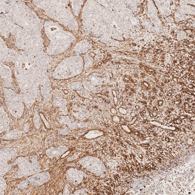 IHC staining of human stomach cancer using 80232-1-RR Immunohistochemistry (IHC) staining of human stomach cancer tissue using Vimentin Recombinant monoclonal antibody (80232-1-RR)