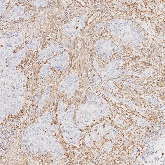 IHC staining of human stomach cancer using 80232-1-RR Immunohistochemistry (IHC) staining of human stomach cancer tissue using Vimentin Recombinant monoclonal antibody (80232-1-RR)
