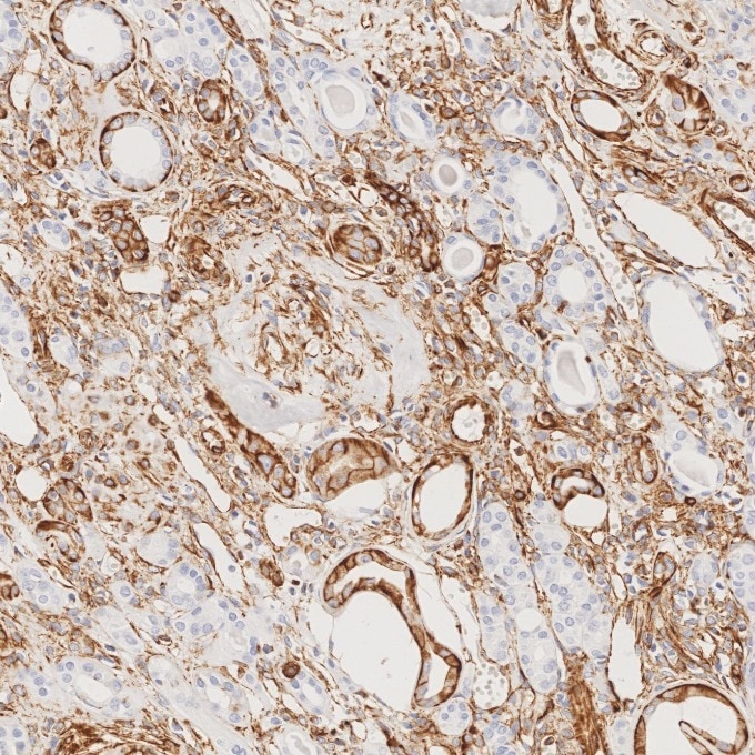 IHC staining of human renal cell carcinoma using 80232-1-RR Immunohistochemistry (IHC) staining of human renal cell carcinoma tissue using Vimentin Recombinant monoclonal antibody (80232-1-RR)