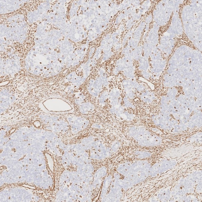 IHC staining of human ovary cancer using 80232-1-RR Immunohistochemistry (IHC) staining of human ovary cancer tissue using Vimentin Recombinant monoclonal antibody (80232-1-RR)