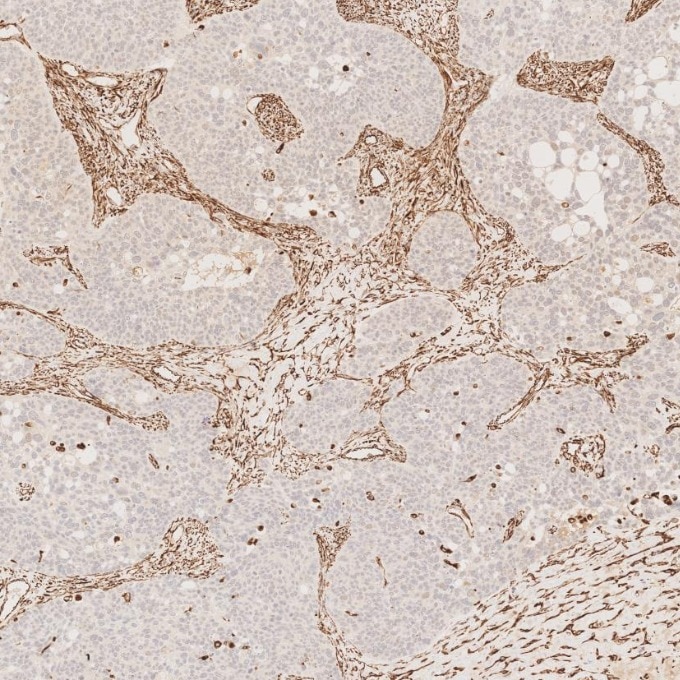 IHC staining of human ovary cancer using 80232-1-RR Immunohistochemistry (IHC) staining of human ovary cancer tissue using Vimentin Recombinant monoclonal antibody (80232-1-RR)