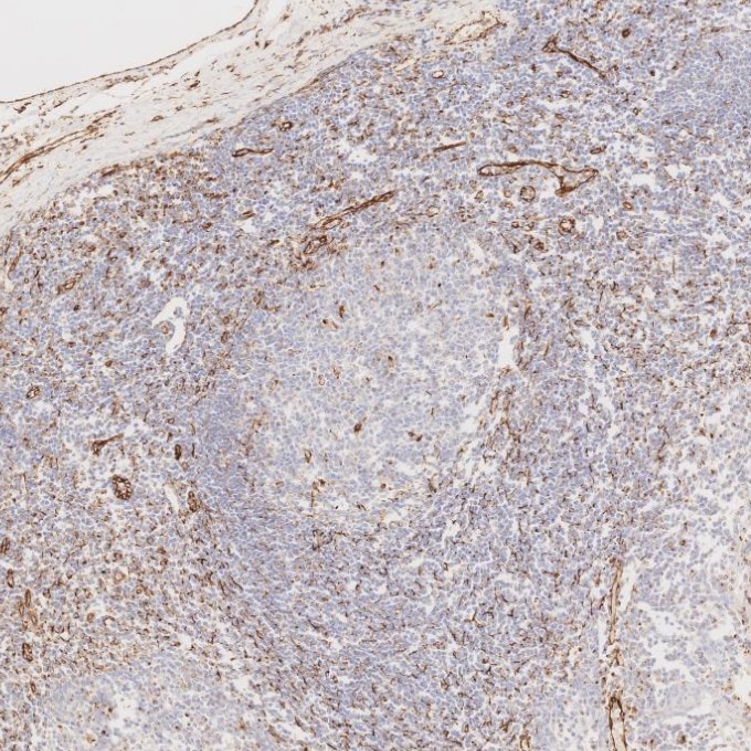 IHC staining of human tonsillitis using 80232-1-RR Immunohistochemistry (IHC) staining of human tonsillitis tissue using Vimentin Recombinant monoclonal antibody (80232-1-RR)