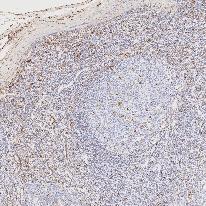 IHC staining of human tonsillitis using 80232-1-RR Immunohistochemistry (IHC) staining of human tonsillitis tissue using Vimentin Recombinant monoclonal antibody (80232-1-RR)