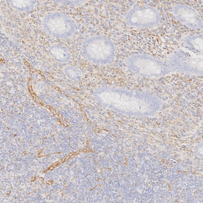 IHC staining of human appendicitis using 80232-1-RR Immunohistochemistry (IHC) staining of human appendicitis tissue using Vimentin Recombinant monoclonal antibody (80232-1-RR)