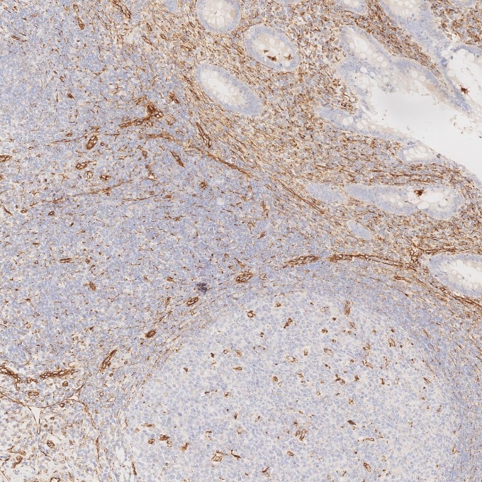 IHC staining of human appendicitis using 80232-1-RR Immunohistochemistry (IHC) staining of human appendicitis tissue using Vimentin Recombinant monoclonal antibody (80232-1-RR)