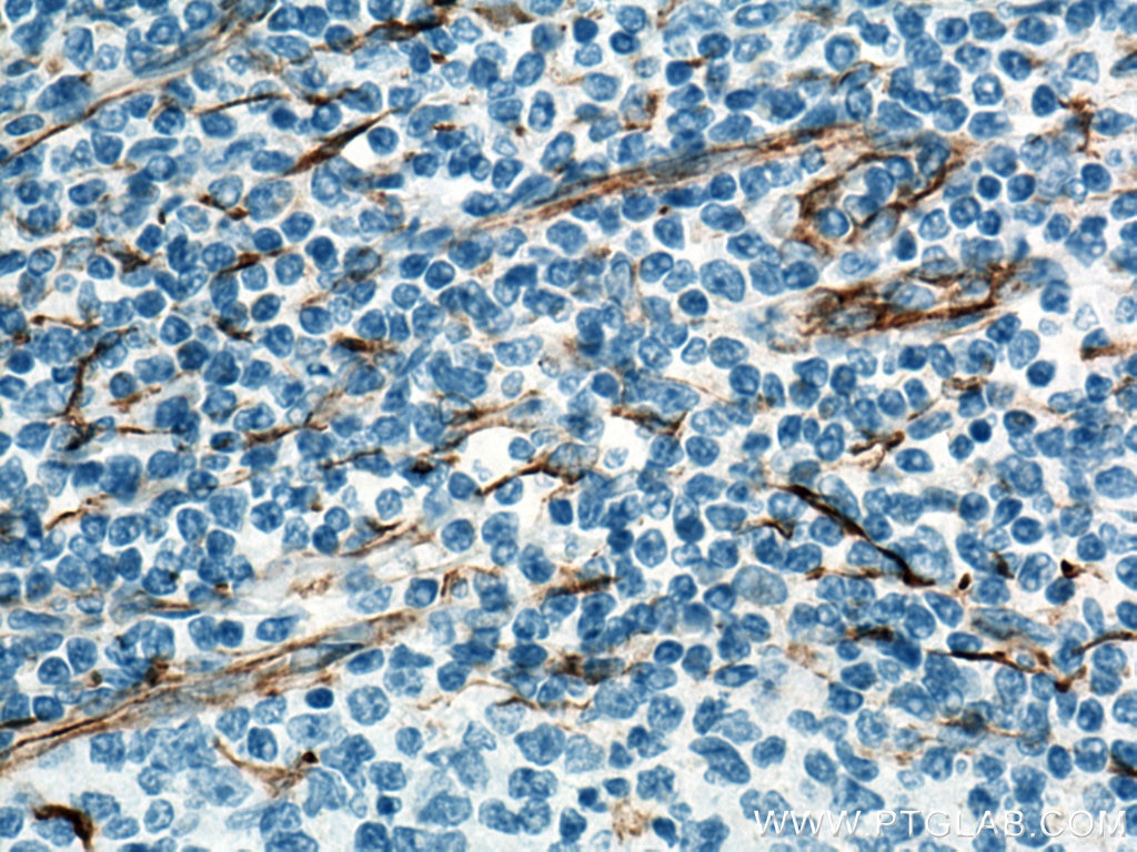Immunohistochemistry (IHC) staining of human tonsillitis tissue using Biotin-conjugated Vimentin Monoclonal antibody (Biotin-60330)