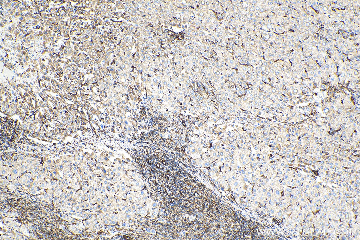 Immunohistochemistry (IHC) staining of human liver cancer tissue using Biotin-conjugated Vimentin Monoclonal antibody (Biotin-60330)