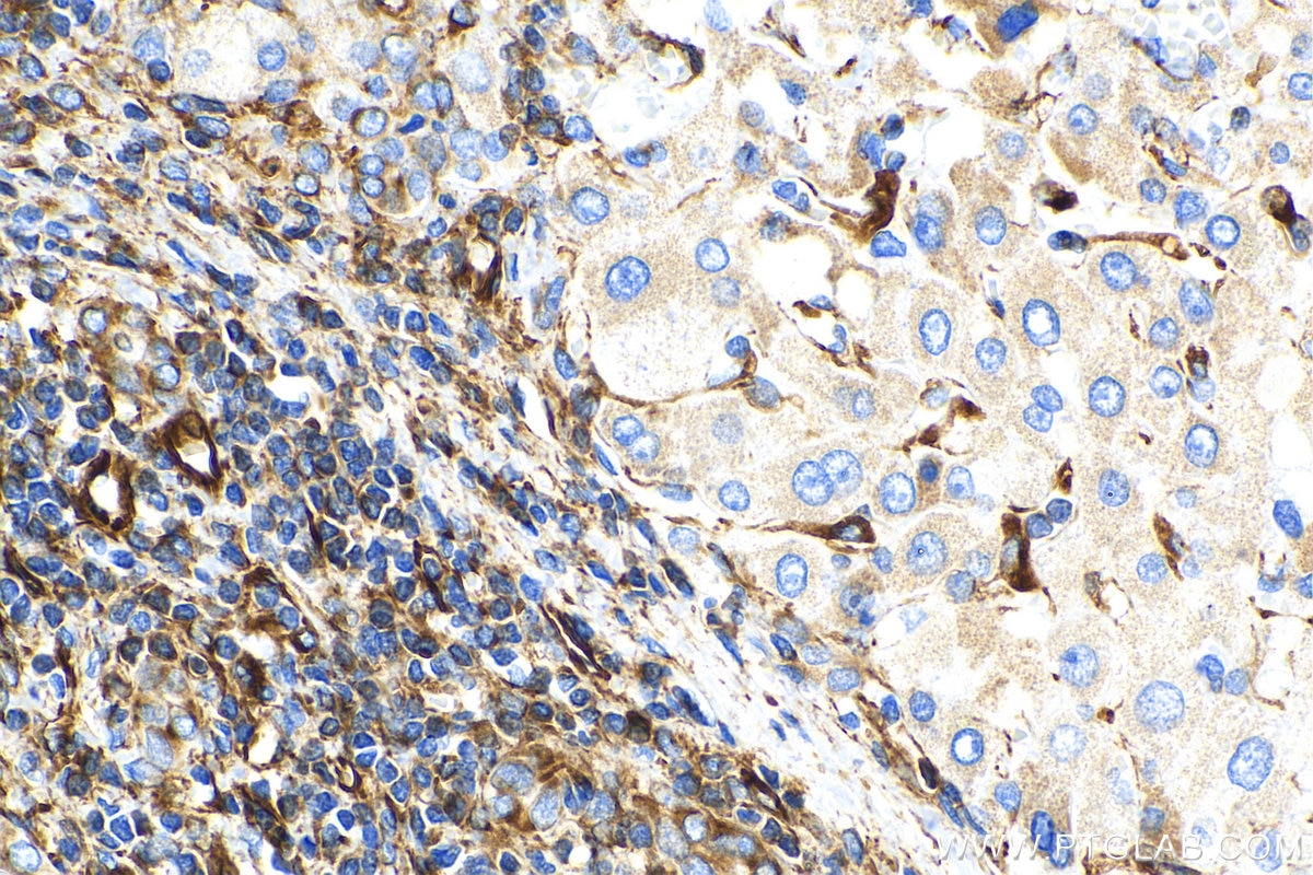 Immunohistochemistry (IHC) staining of human liver cancer tissue using Biotin-conjugated Vimentin Monoclonal antibody (Biotin-60330)