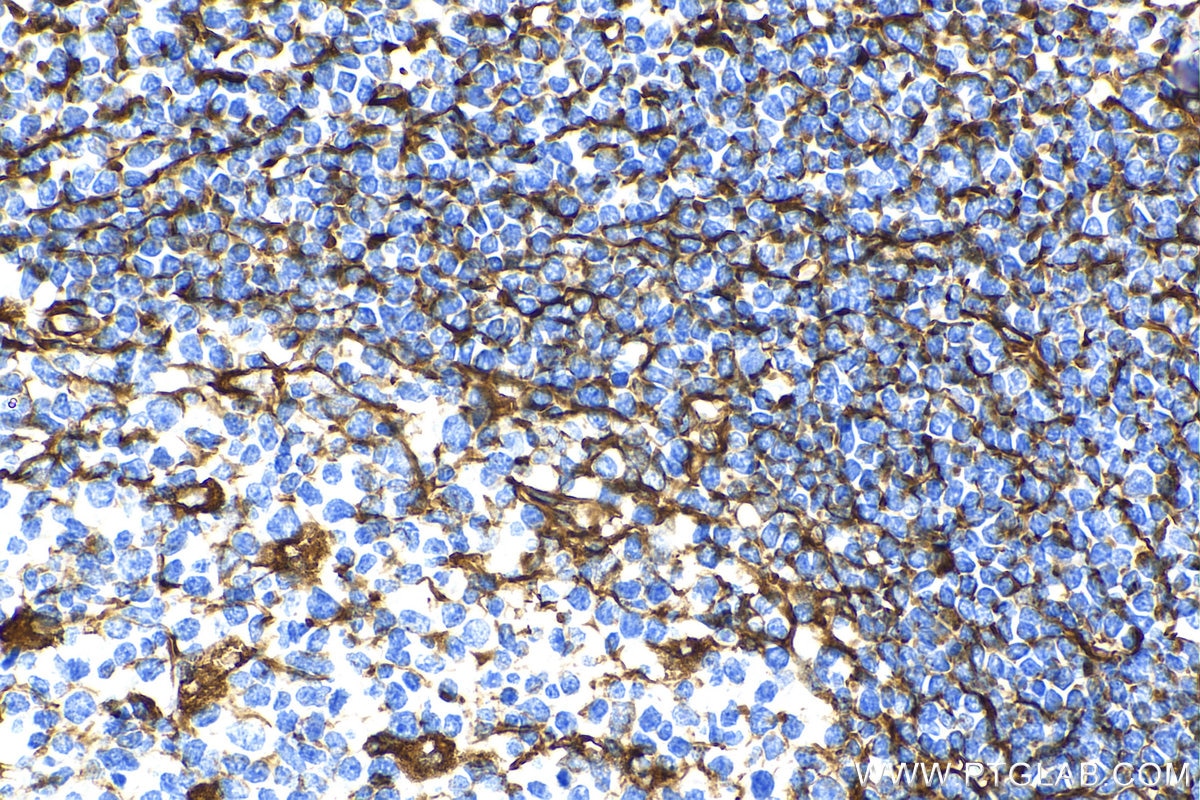 Immunohistochemistry (IHC) staining of human tonsillitis tissue using Biotin-conjugated Vimentin Monoclonal antibody (Biotin-60330)