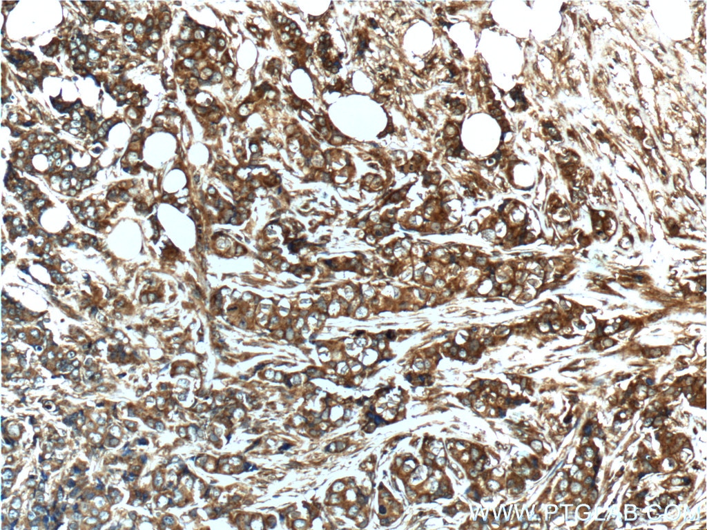 Immunohistochemistry (IHC) staining of human breast cancer tissue using Vinculin Polyclonal antibody (26520-1-AP)