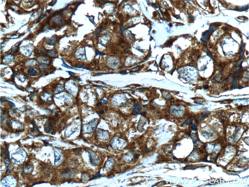 Immunohistochemistry (IHC) staining of human breast cancer tissue using Vinculin Polyclonal antibody (26520-1-AP)