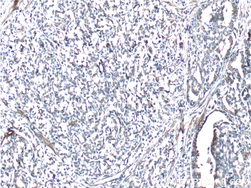Immunohistochemistry (IHC) staining of human prostate cancer tissue using Vinculin Polyclonal antibody (26520-1-AP)