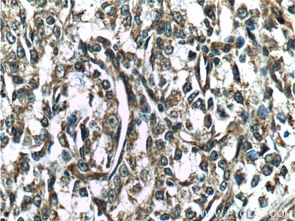 Immunohistochemistry (IHC) staining of human prostate cancer tissue using Vinculin Polyclonal antibody (26520-1-AP)