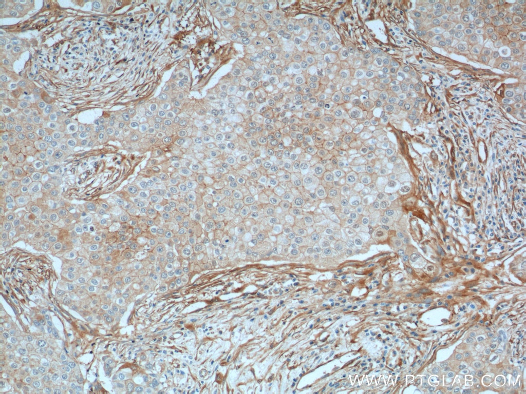 Immunohistochemistry (IHC) staining of human breast cancer tissue using Vinculin Monoclonal antibody (66305-1-Ig)