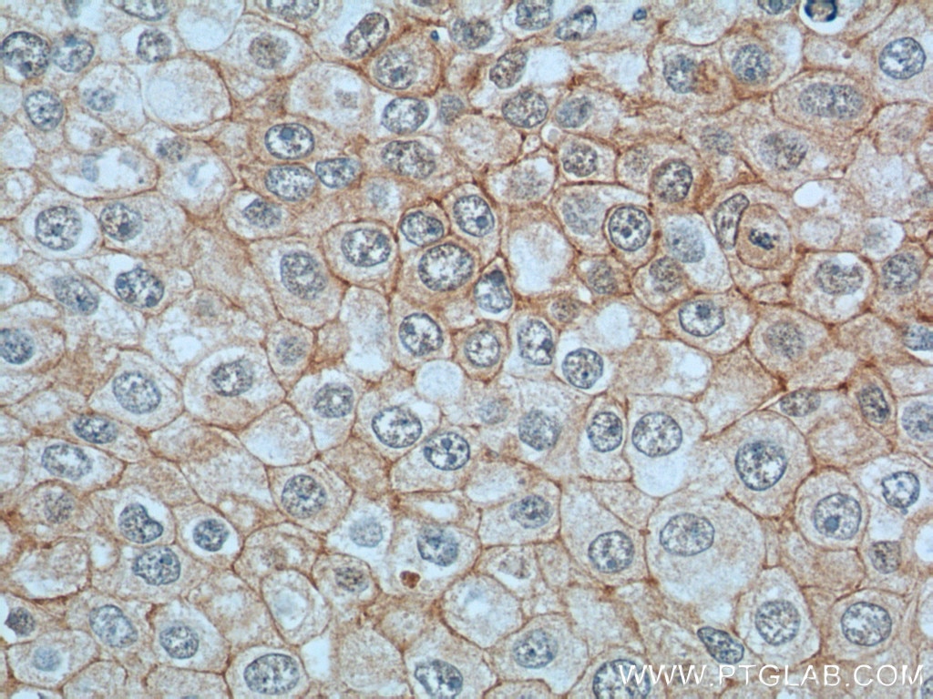 Immunohistochemistry (IHC) staining of human breast cancer tissue using Vinculin Monoclonal antibody (66305-1-Ig)
