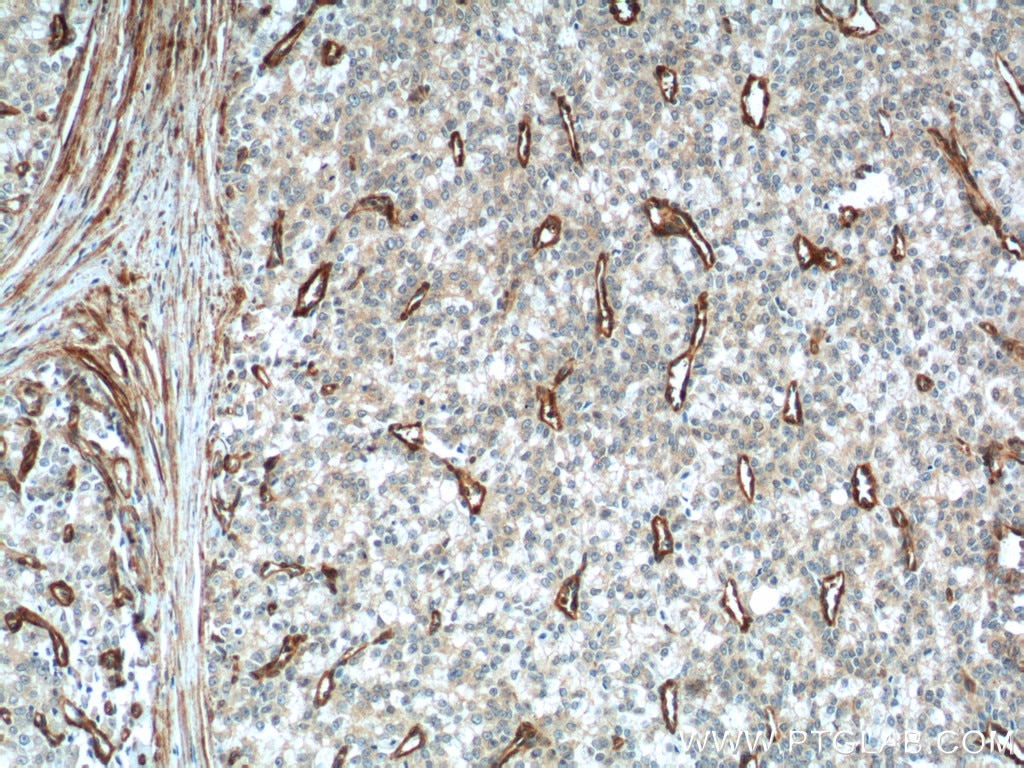 Immunohistochemistry (IHC) staining of human prostate cancer tissue using Vinculin Monoclonal antibody (66305-1-Ig)