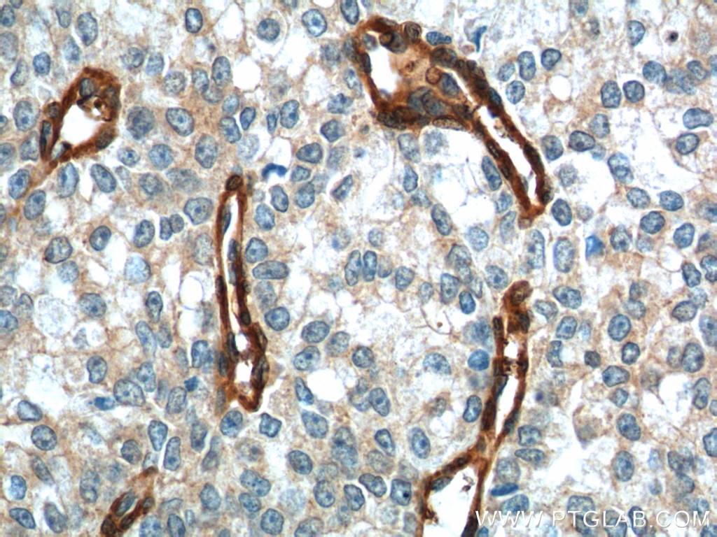 IHC staining of human prostate cancer using 66305-1-Ig