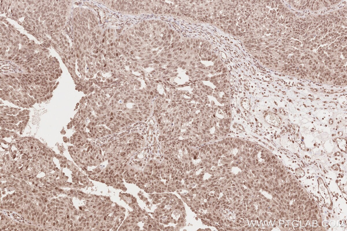 Immunohistochemistry (IHC) staining of human ovary cancer tissue using WAPL Polyclonal antibody (16370-1-AP)