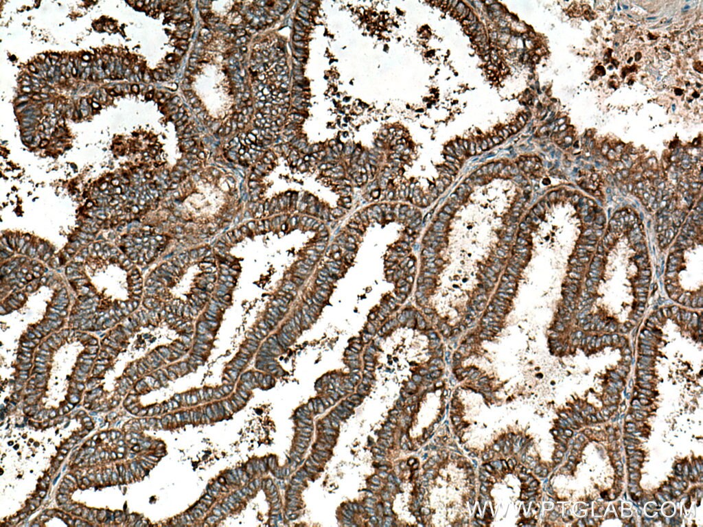 Immunohistochemistry (IHC) staining of human ovary tumor tissue using TrpRS Polyclonal antibody (16081-1-AP)