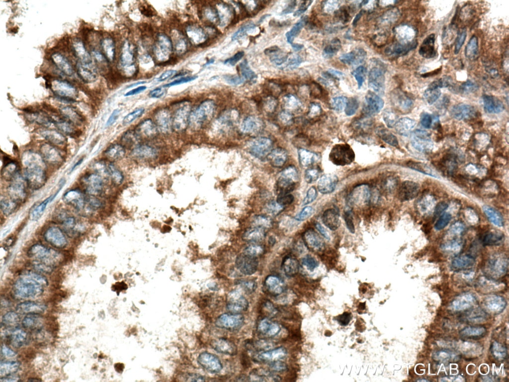 Immunohistochemistry (IHC) staining of human ovary tumor tissue using TrpRS Polyclonal antibody (16081-1-AP)
