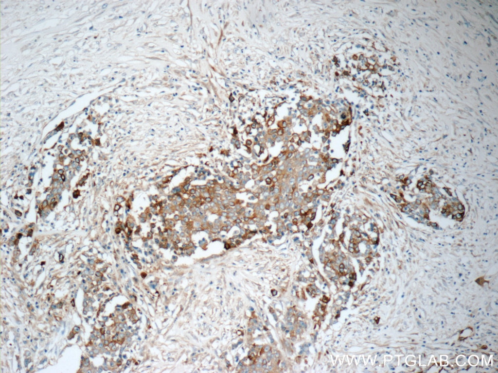 Immunohistochemistry (IHC) staining of human colon cancer tissue using TrpRS Polyclonal antibody (16081-1-AP)