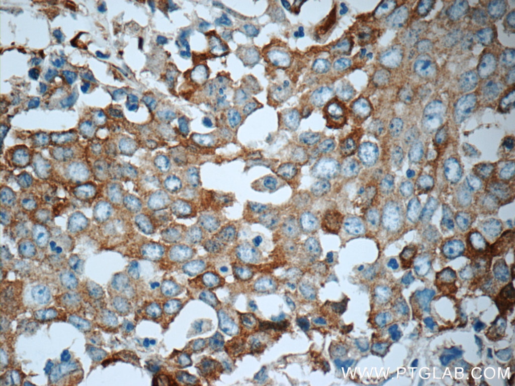 Immunohistochemistry (IHC) staining of human colon cancer tissue using TrpRS Polyclonal antibody (16081-1-AP)
