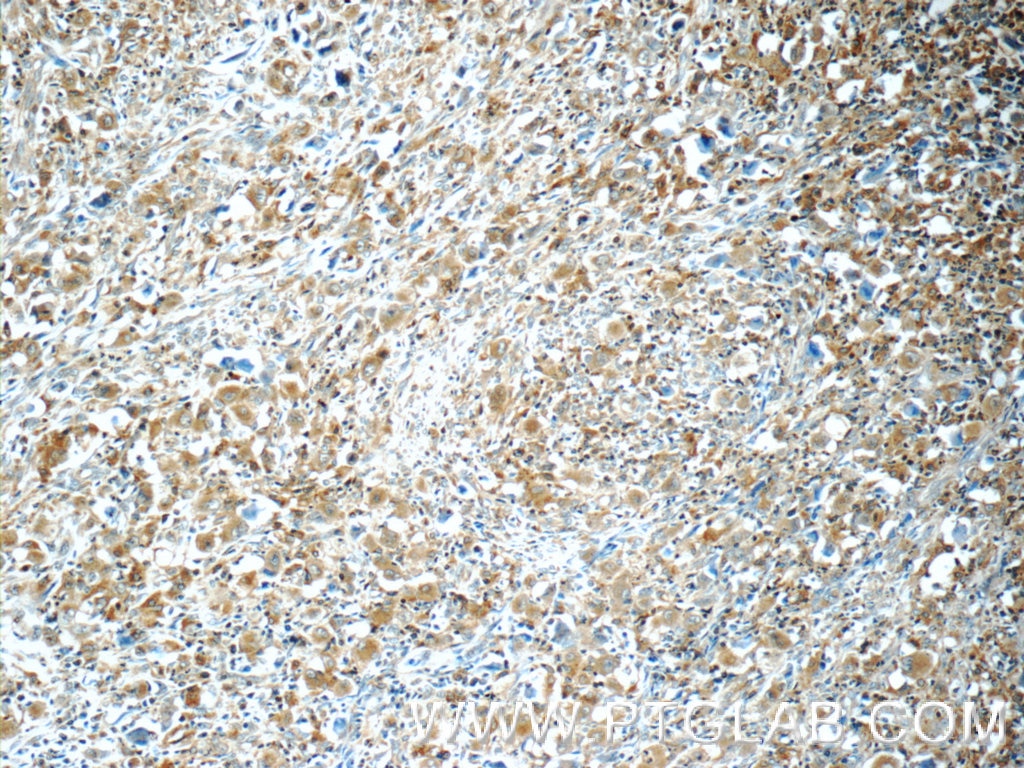 Immunohistochemistry (IHC) staining of human lymphoma tissue using WASP Polyclonal antibody (10987-1-AP)