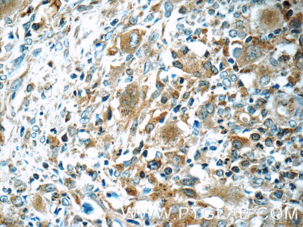 Immunohistochemistry (IHC) staining of human lymphoma tissue using WASP Polyclonal antibody (10987-1-AP)