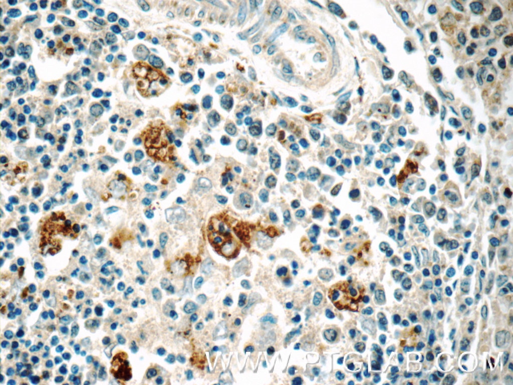 Immunohistochemistry (IHC) staining of human spleen tissue using WASP Polyclonal antibody (10987-1-AP)