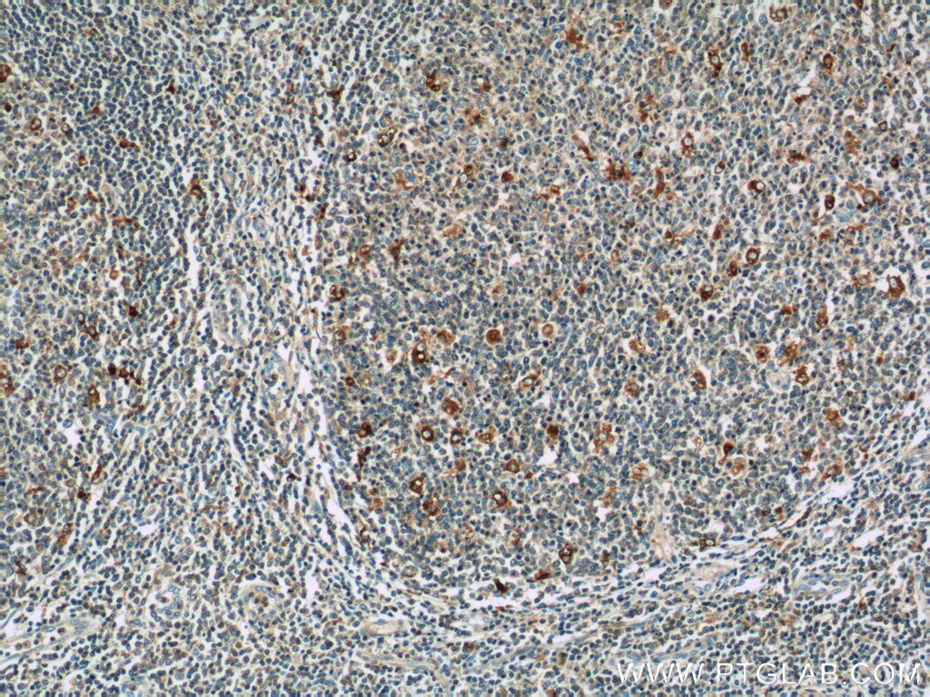 Immunohistochemistry (IHC) staining of human tonsillitis tissue using WASP Polyclonal antibody (10987-1-AP)