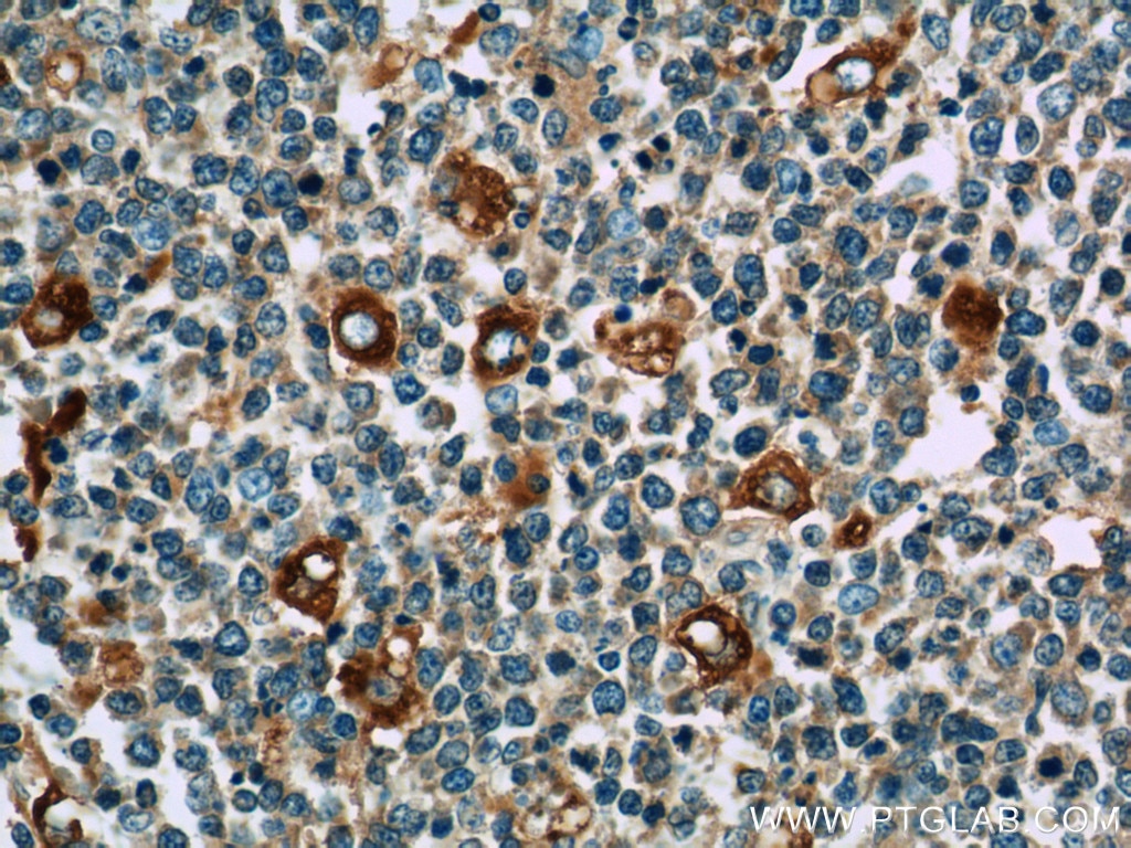 Immunohistochemistry (IHC) staining of human tonsillitis tissue using WASP Polyclonal antibody (10987-1-AP)
