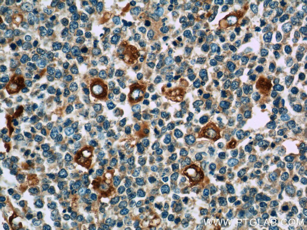 IHC staining of human tonsillitis using 10987-1-AP