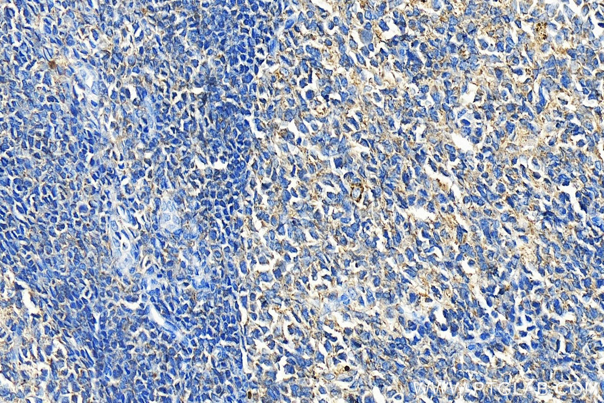 Immunohistochemistry (IHC) staining of human tonsillitis tissue using WASP Polyclonal antibody (10987-1-AP)