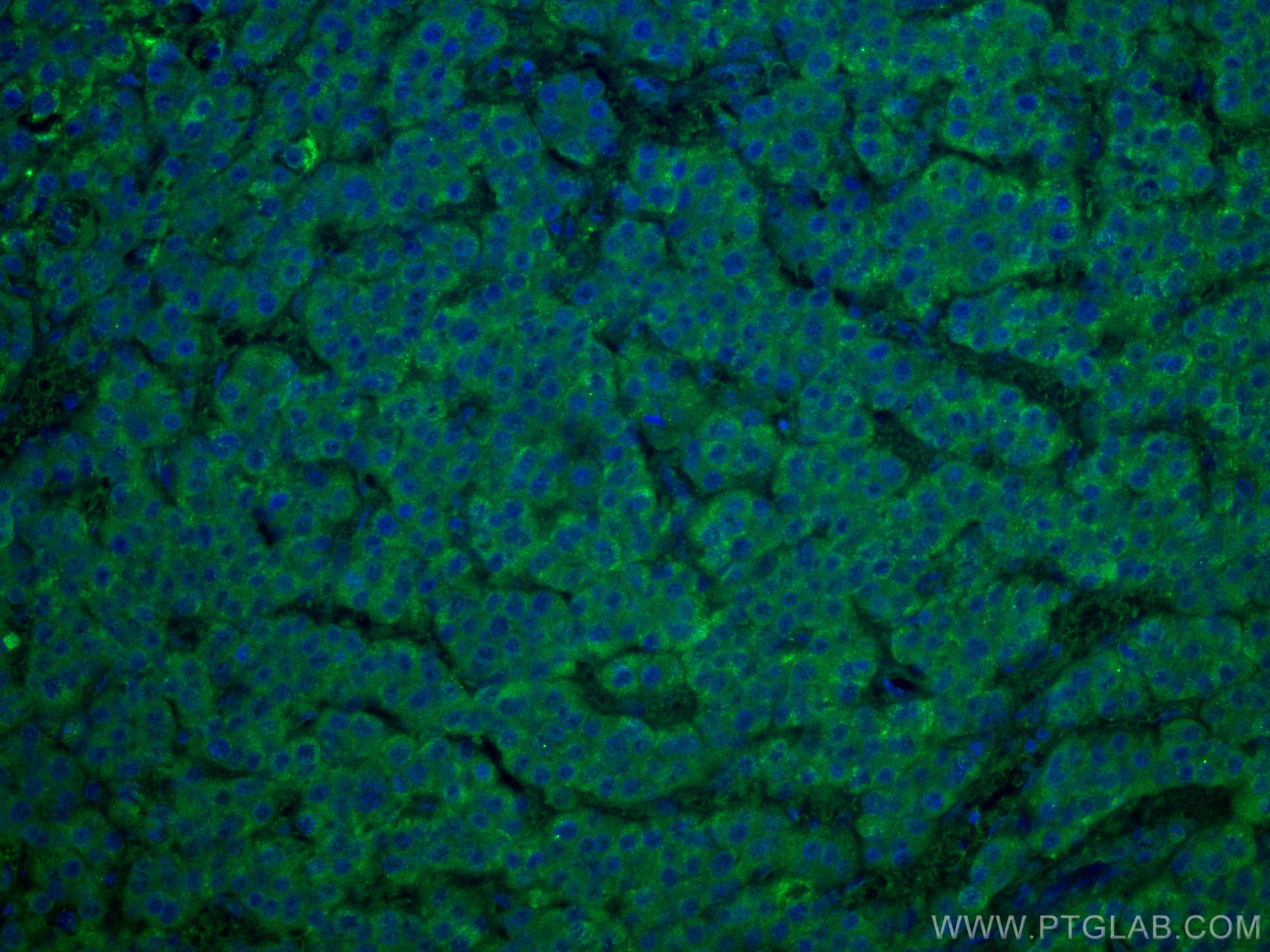 Immunofluorescence (IF) / fluorescent staining of human liver cancer tissue using WASF3 Monoclonal antibody (67620-1-Ig)