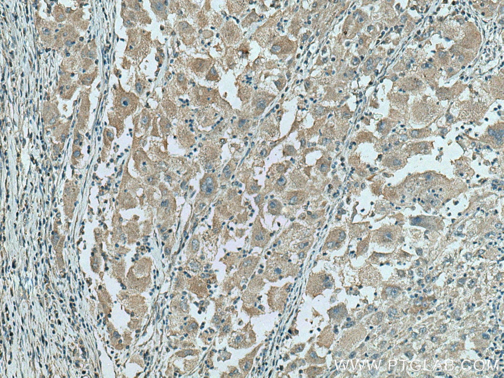 Immunohistochemistry (IHC) staining of human liver cancer tissue using WASF3 Monoclonal antibody (67620-1-Ig)
