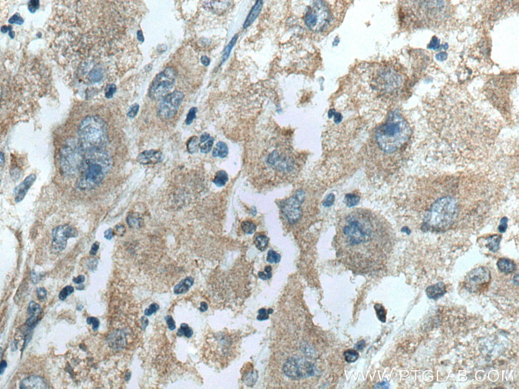 Immunohistochemistry (IHC) staining of human liver cancer tissue using WASF3 Monoclonal antibody (67620-1-Ig)