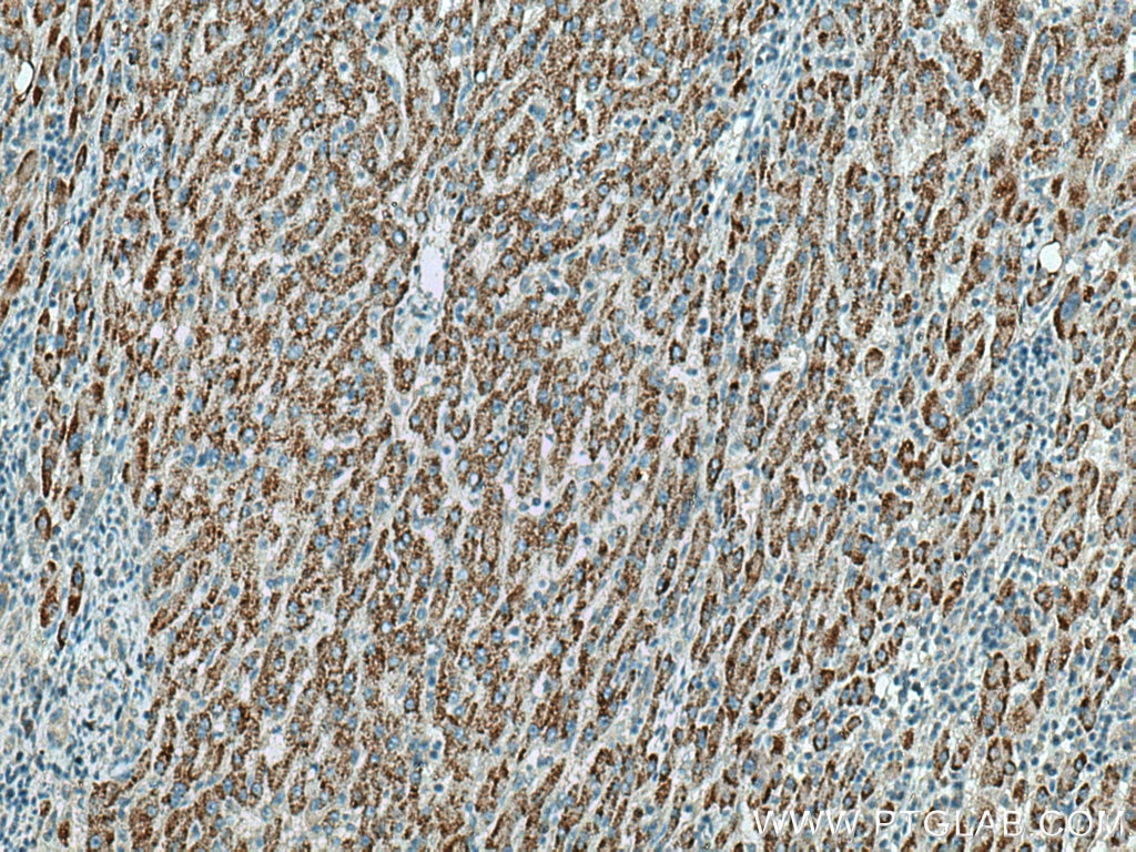 IHC staining of human liver cancer using 67620-1-Ig