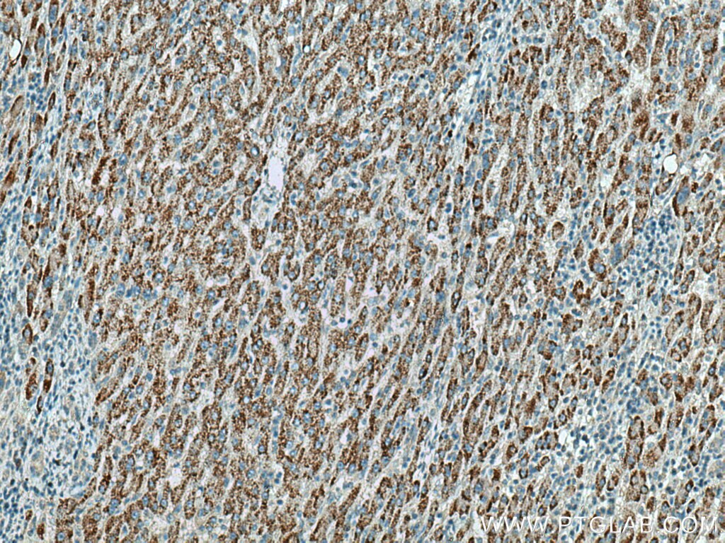 Immunohistochemistry (IHC) staining of human liver cancer tissue using WASF3 Monoclonal antibody (67620-1-Ig)