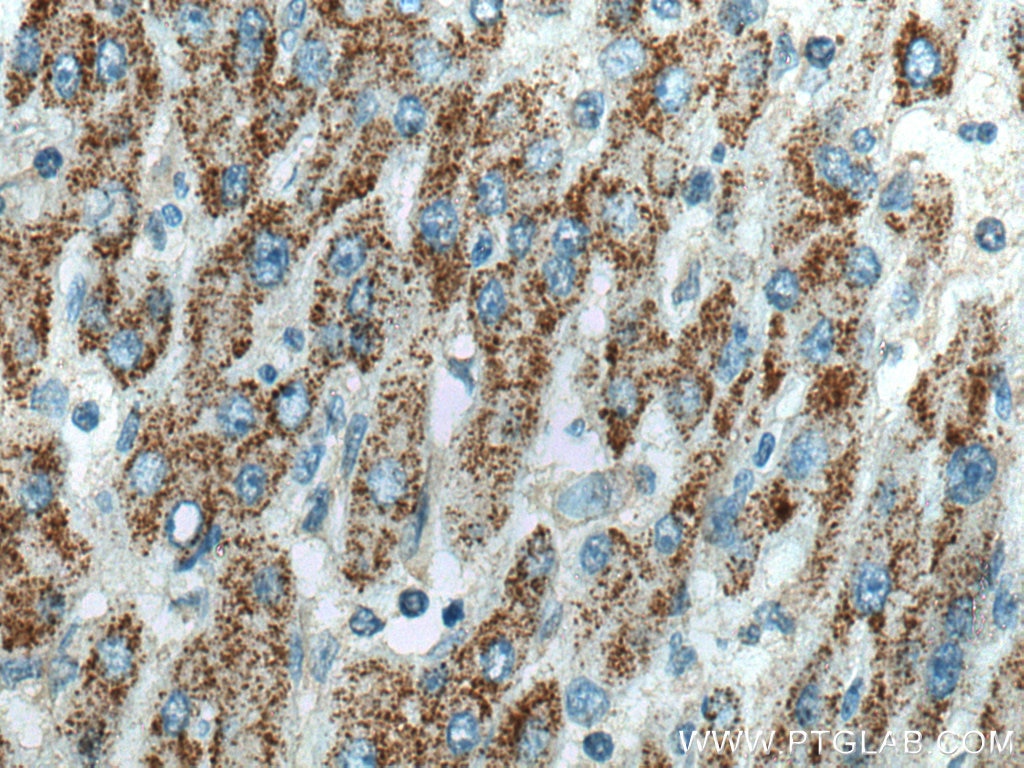 Immunohistochemistry (IHC) staining of human liver cancer tissue using WASF3 Monoclonal antibody (67620-1-Ig)
