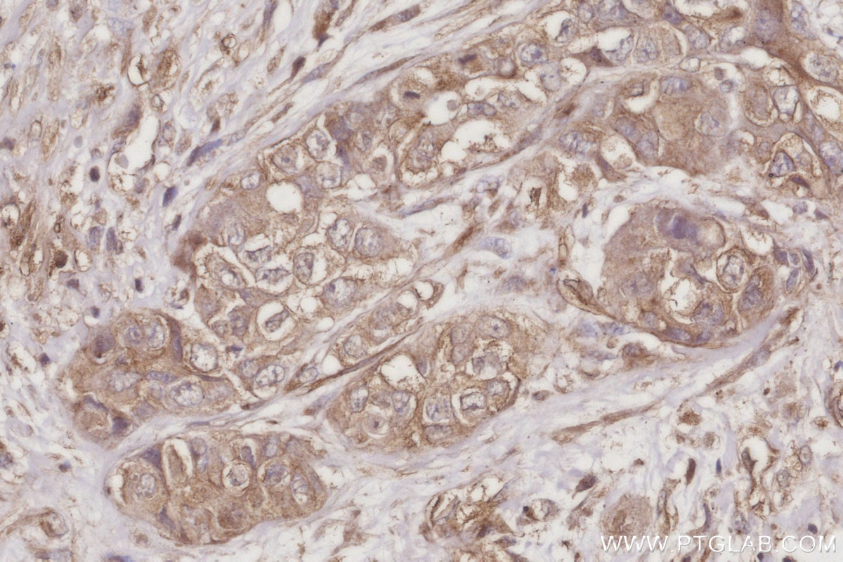 Immunohistochemistry (IHC) staining of human pancreas cancer tissue using WASF3 Monoclonal antibody (67620-1-Ig)