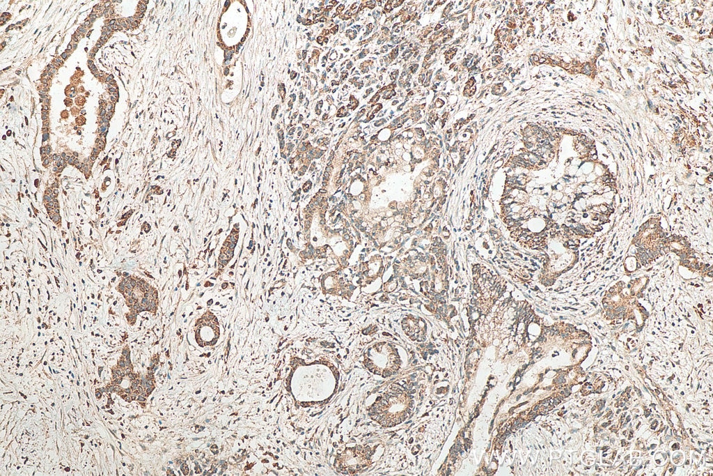 Immunohistochemistry (IHC) staining of human pancreas cancer tissue using WBP1 Polyclonal antibody (11042-1-AP)